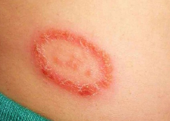 Viêm da thể đồng tiền: Triệu chứng nhận biết và cách điều trị