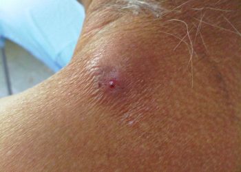 Myiasis da là bệnh gì, có nguy hiểm không?