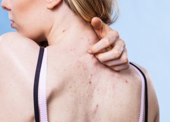 Cách xử lý mụn lưng hiệu quả cho cả nam và nữ giới