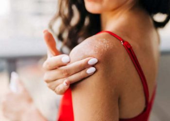 Làm gì khi da bị dị ứng kem chống nắng?