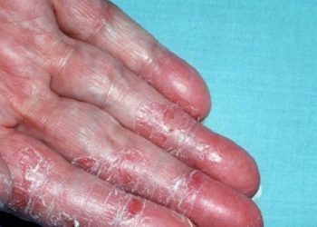 Dày sừng lòng bàn tay – bàn chân và cách điều trị