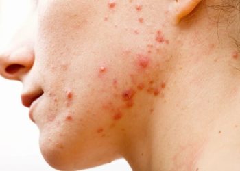 7 bệnh nhiễm trùng da do vi khuẩn thường gặp