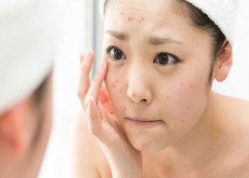 Mách bạn cách dùng thuốc trị mụn sao cho hiệu quả
