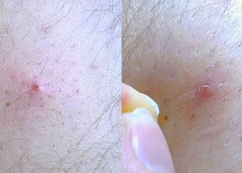 Lông mọc ngược và cách khắc phục