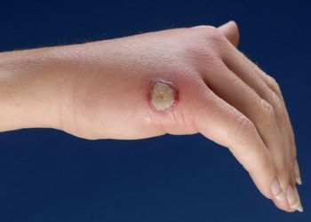 Viêm da mủ hoại thư và cách điều trị hiệu quả