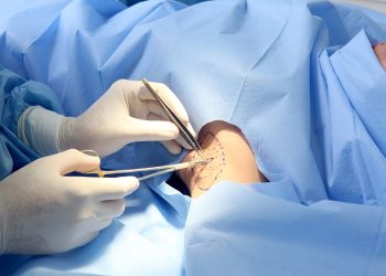 Cắt tuyến mồ hôi nách – mọi điều nên biết trước khi phẫu thuật
