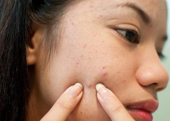 Sạch mụn trứng cá trong 1 đêm để đón tết rạng rỡ
