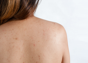 Các loại thuốc trị viêm nang lông và lưu ý khi sử dụng