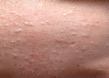 Mụn ẩn là gì và cách xử lý nhanh gọn mụn ẩn