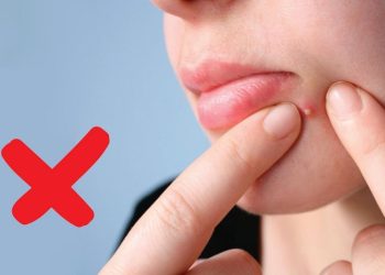 Hướng dẫn nặn mụn đúng cách để quên nỗi lo về sẹo