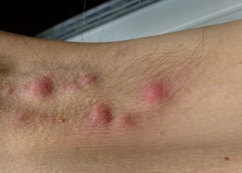 Bệnh viêm tuyến mồ hôi mủ – nhận diện và xử trí