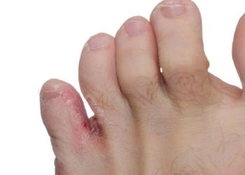 Nước ăn chân tay là gì, xử lý như thế nào?