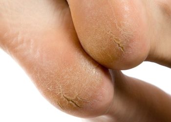 Bị nứt gót phải làm gì để lấy lại vẻ đẹp gót hồng?