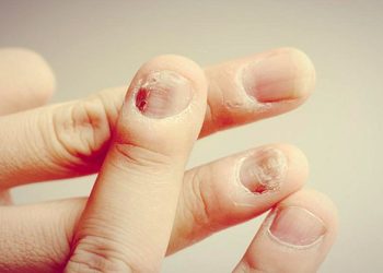 Nứt móng tay chân – dấu hiệu cảnh báo bệnh nấm móng