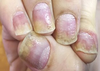Móng tay bị rỗ do những nguyên nhân nào?