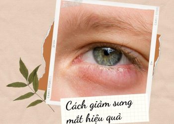 Nguyên nhân sưng mắt? Bật mí 9 cách giảm sưng mắt đơn giản nhất