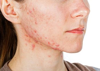 Bật mí chế độ ăn uống giúp ngăn ngừa mụn nội tiết tố cực kì hiệu quả