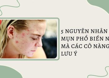 5 nguyên nhân gây mụn phổ biến nhất mà các cô nàng cần lưu ý