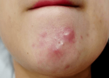 Mụn chai là gì? Cách điều trị và phòng ngừa ra sao?
