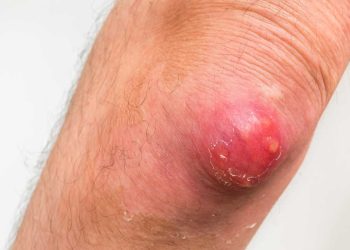 Hậu bối là gì? Bệnh nguy hiểm như thế nào?