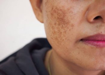 Rối loạn sắc tố da và cách điều trị hiệu quả