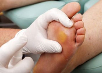 Chai chân là do đâu? Điều trị bằng cách nào?