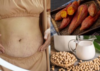 Ăn khoai lang, đậu nành làm mờ vết rạn da sau sinh
