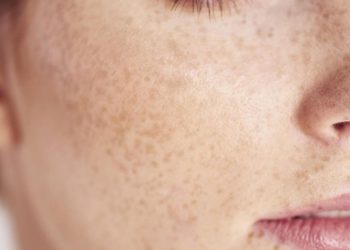 Da tàn nhang, đốm đen tuyệt đối không dùng retinol