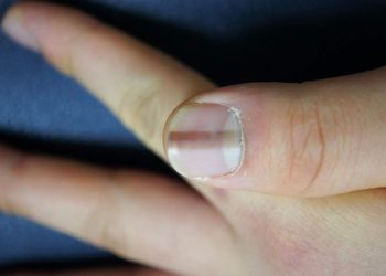 Móng tay đen là dấu hiệu của bệnh gì?