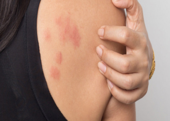 Thuốc trị giời leo gồm những loại nào? Cần lưu ý gì khi sử dụng?