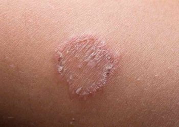 Thuốc trị lác đồng tiền gồm những loại nào?