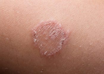 Điểm danh các loại thuốc hắc lào hiệu quả được bác sĩ khuyên dùng