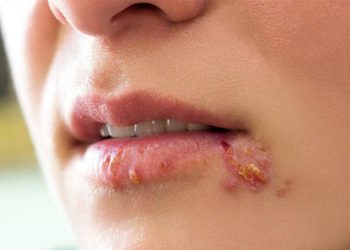 Mụn ở mép môi có nguy hiểm không?